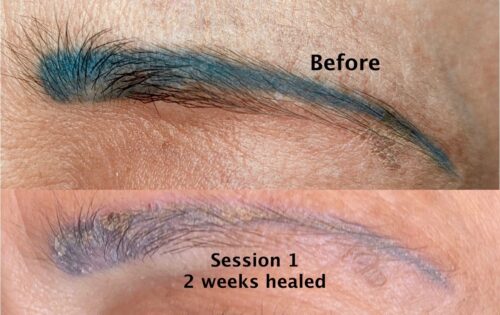 tattoo removal on eyebrows before and 2 weeks after