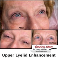 Upper Lash line Enhancement Before and After